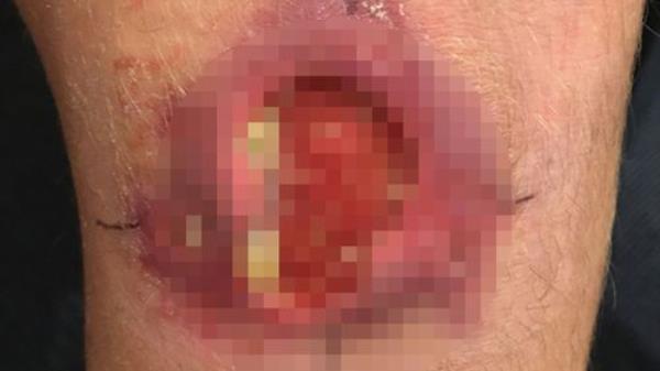 The Buruli ulcer is a serious co<em></em>ndition that needs to be treated early.